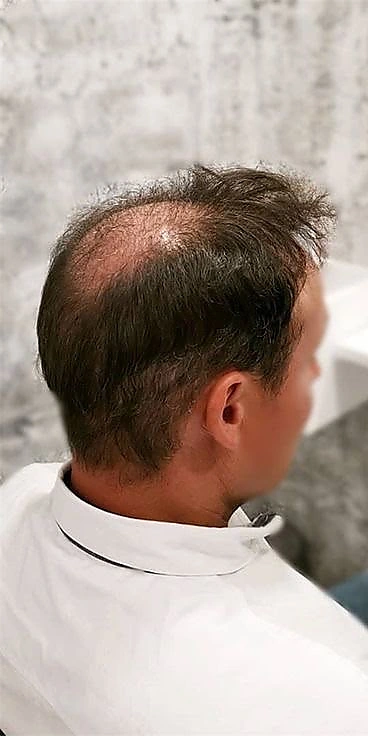 Before: thinning hair shown from an angled side view